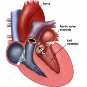 Critical Aortic Stenosis Archives - Growing Your Baby