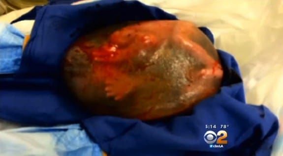 26 week preemie baby born in his amniotic sac