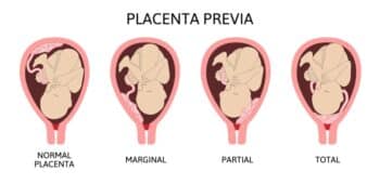 Placenta Previa