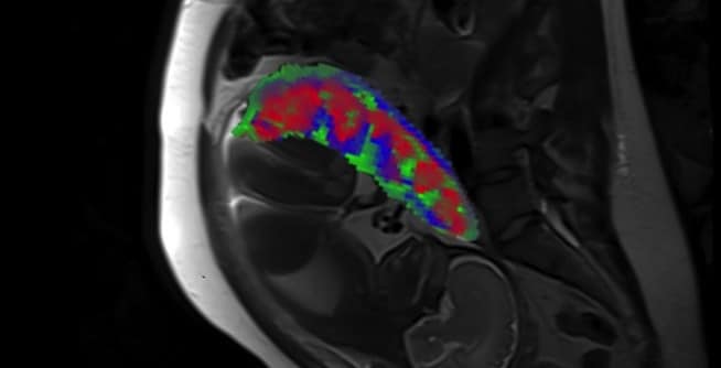 New MRI Method Provides Better Imaging Of The Placenta During Pregnancy