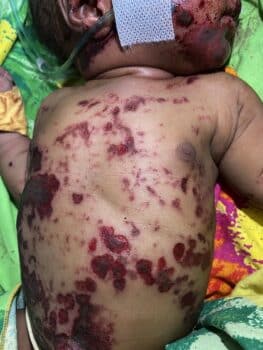 Photograph taken in the emergency department of a newborn miraculously surviving being buried alive - showing scattered abrasions and bruises