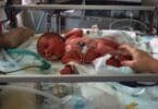 Newborn preemie in neonatal intensive care unit