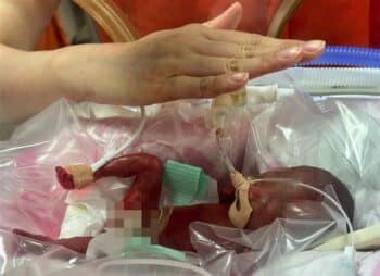 Baby Born at 22 Weeks Defies Odds in Shanghai