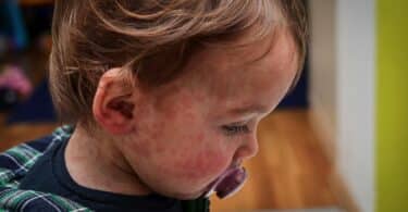 Red measles rash on baby