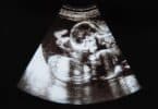 twin pregnancy ultrasound