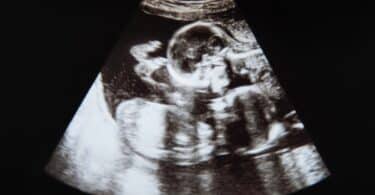 twin pregnancy ultrasound