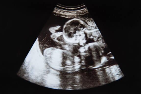 twin pregnancy ultrasound