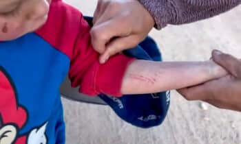 The small scrapes on Bodin Allen's arms