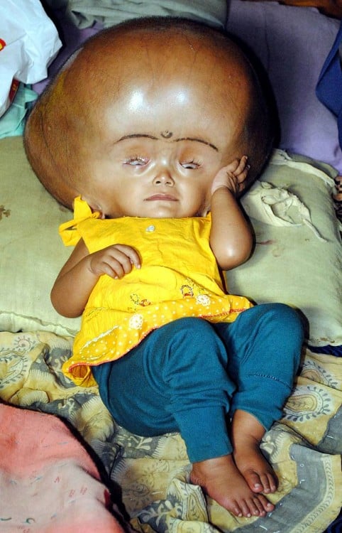 Baby from India with Severe Hydrocephalus Discharged This Week from ...